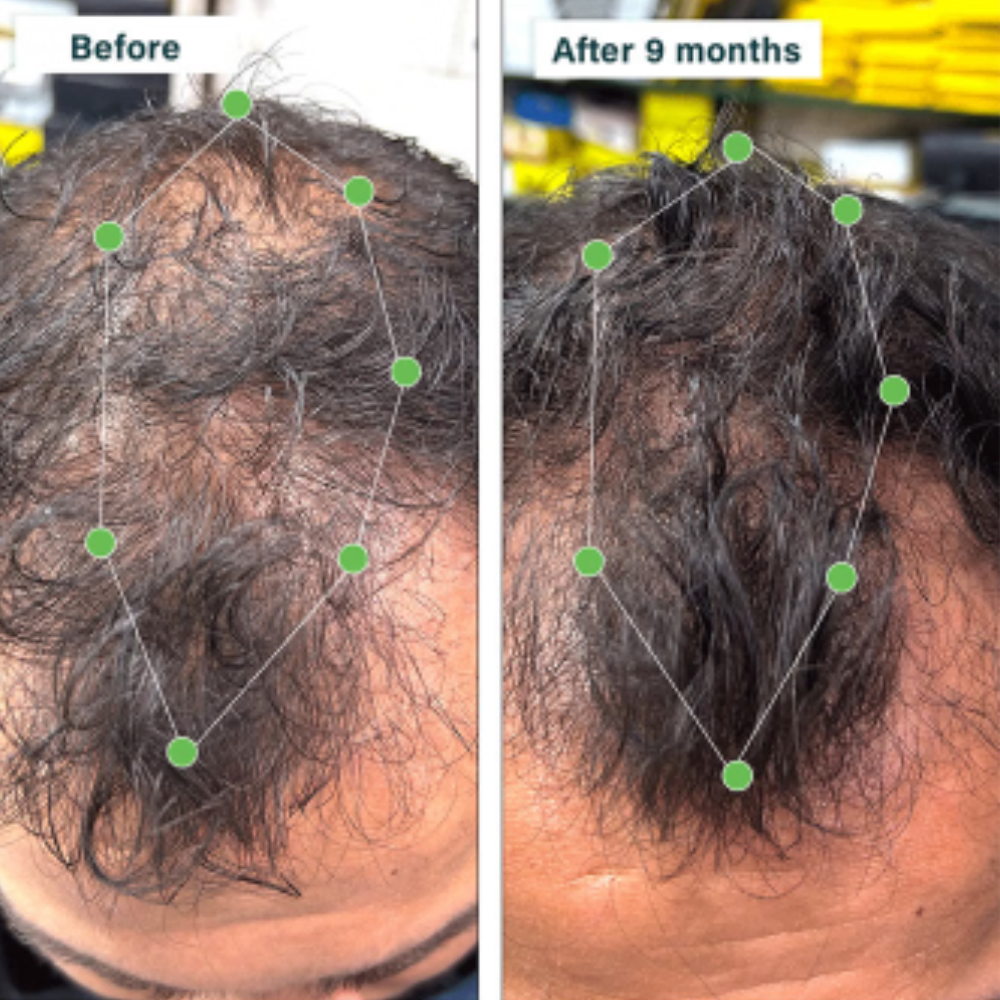 Oziva Hair Vitamins with DHT Blocker & Omega 3 | Vegetarian Capsule for Better Hair Growth & Hair Fall Control - Image 3